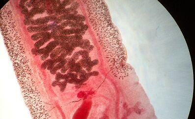 Anquilostomosis in people