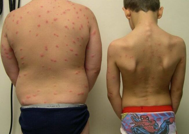 Rash on the skin with worms