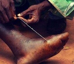 Parasite in a person's leg