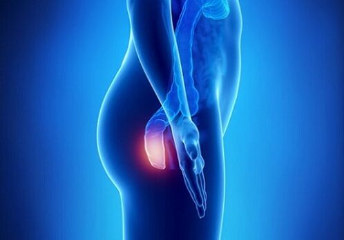 itching in the rectum as an indication for examination of parasites