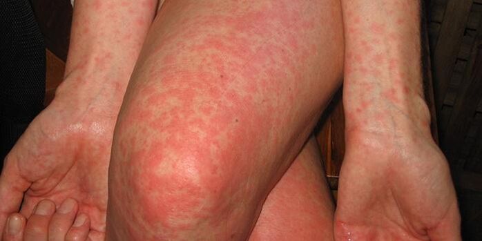 symptoms of parasites in the body